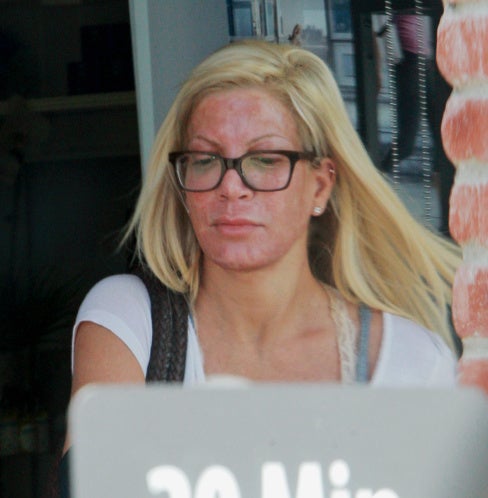Así quedó Tori Spellin con la cara desfigurada luego de tratamiento estético1 (2)