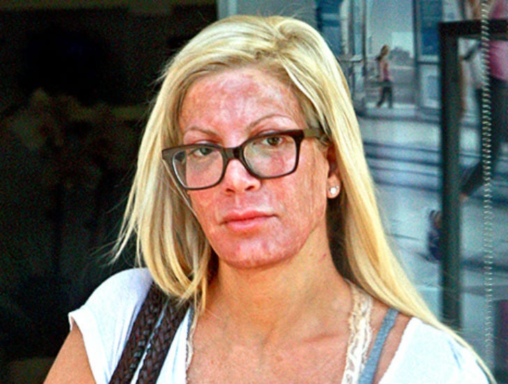 Así quedó Tori Spellin con la cara desfigurada luego de tratamiento estético3